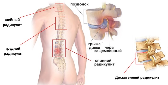 Радикулит классифицируется по месту его локализации
