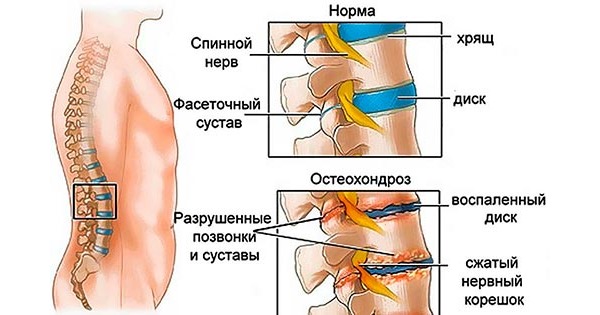 Корешковый синдром возникает при структурном изменении позвонков