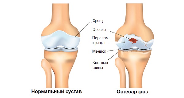 Хондроксид предназначен для лечения артрозов и остеоартрозов всех суставов