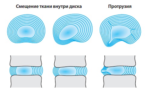 Протрузия диска протекает в несколько этапов