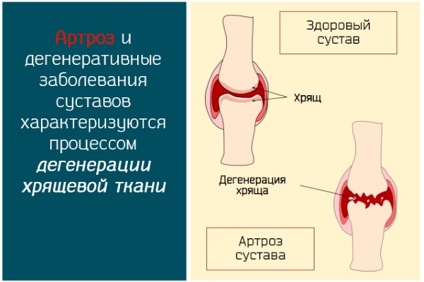 Назначают препарат Долгит при дегенеративно-дистрофических нарушениях в опорно-двигательном аппарате