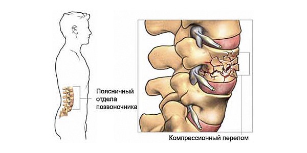 Тянущая боль в спине острого характера свидетельствует о травме позвоночника