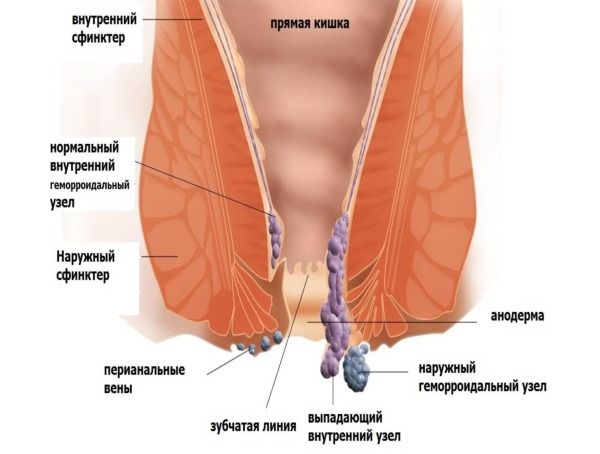 Чаще всего боль в копчике при сидении возникает из-за патологий прямой кишки, такой как геморрой
