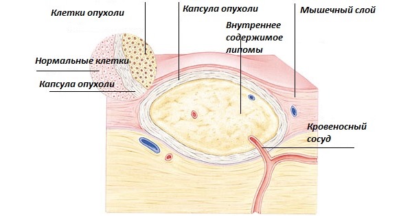 Шишка на позвоночнике может возникнуть из-за доброкачественных опухолей, таких как липома и атерома