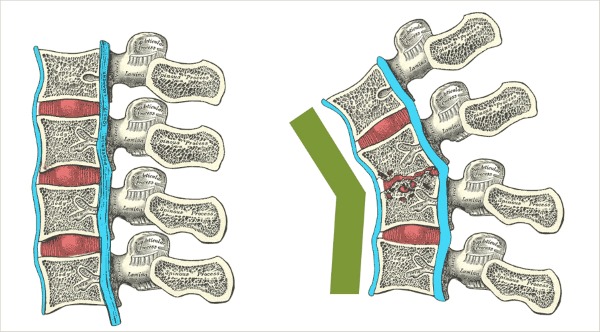 Туберкулезный спондилит провоцирует деформацию и разрушение позвонков