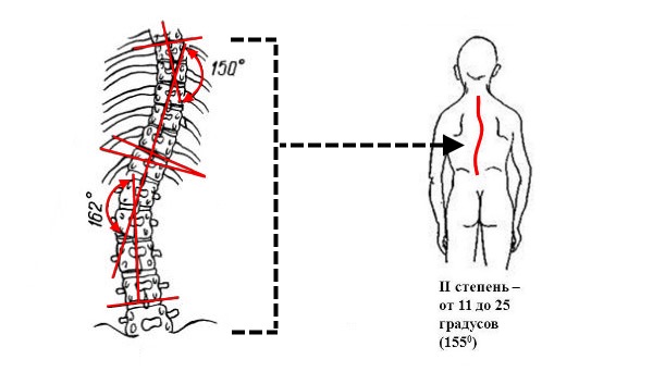 При сколиозе искривление позвоночника уже заметно невооруженным глазом