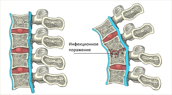 Возбудителем туберкулеза позвоночника выступает палочка Коха