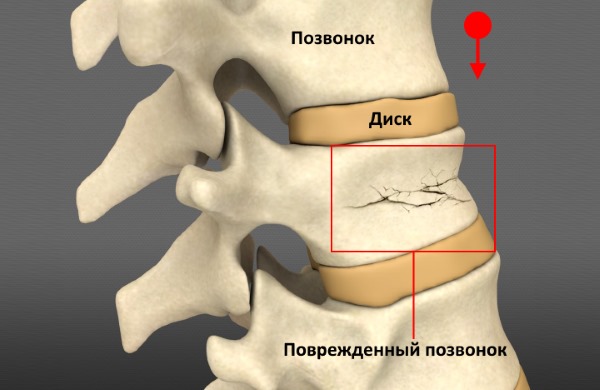 Компрессионный перелом позвоночника - одна из самых частых травм спины