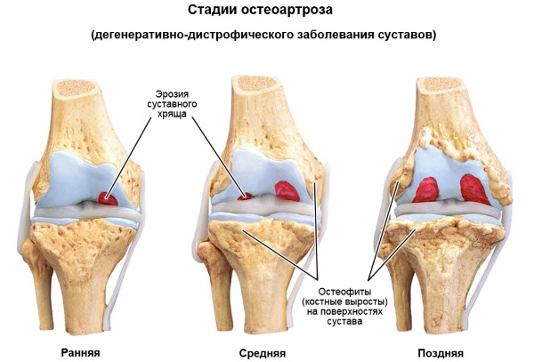 Благодаря своим свойствам Артропант активно применяют для лечения заболеваний суставов