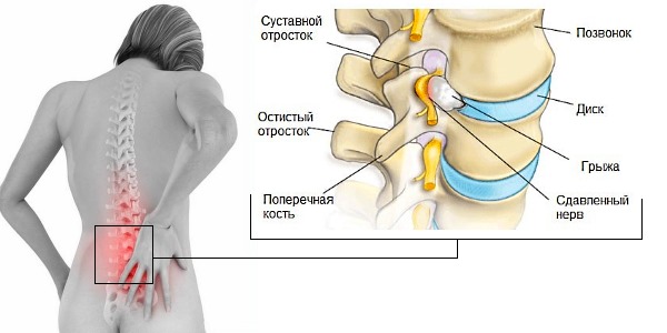 Используют Випратокс при заболеваниях опорно-двигательного аппарата: радикулит, ишиалгия, артралгия