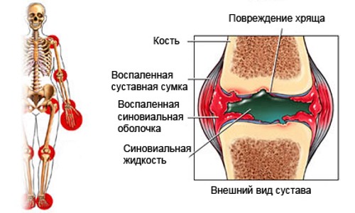 Основными показаниями для применения Би-Ксикама являются ревматоидный артрит и остеоартроз