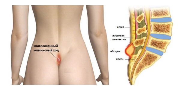 Копчиковая киста имеет вид нагноившейся опухоли