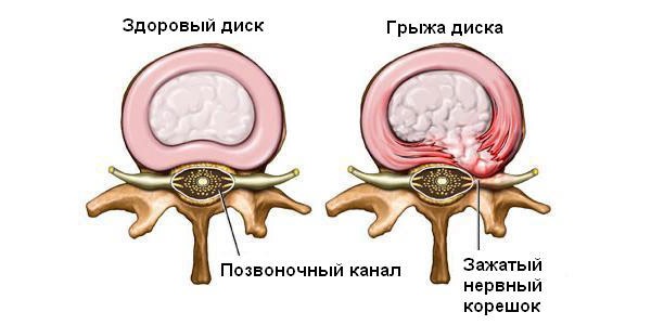 В молодости люди чаще всего страдают от болей в спине по причине межпозвонковой грыжи
