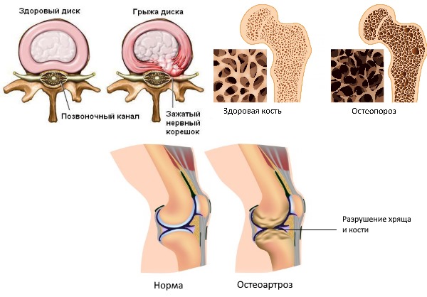 Хондрофлекс включают в терапию дегенеративных патологий позвоночника и других суставов