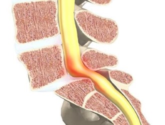 Спондилолистез может привести к защемлению нерва и позвоночной артерии