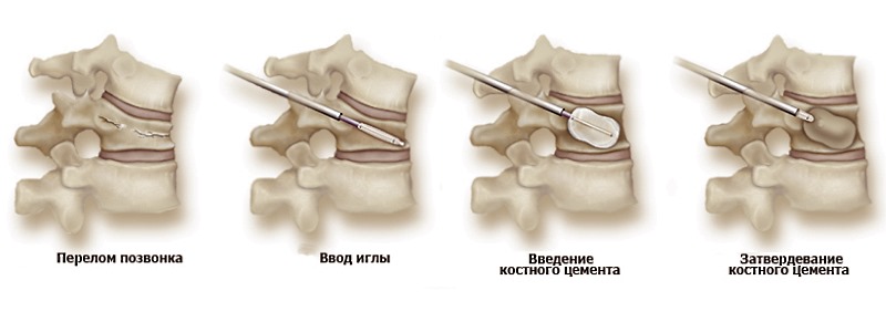 Вертебропластика позвоночника - укрепление позвонка с помощью специального цемента