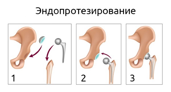 Самой дорогой операцией в области ортопедии является протезирование шейки бедра