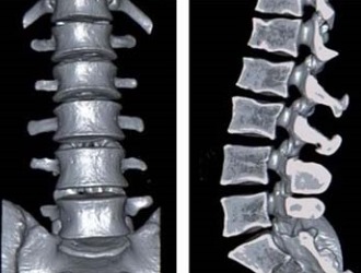 Рентген с функциональными пробами делают в боковой проекции в точках сгибания позвоночника