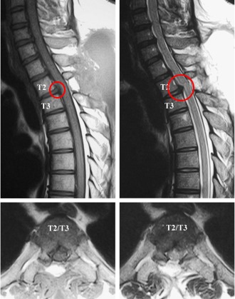 Самой эффективной для диагностики протрузий является МР томография