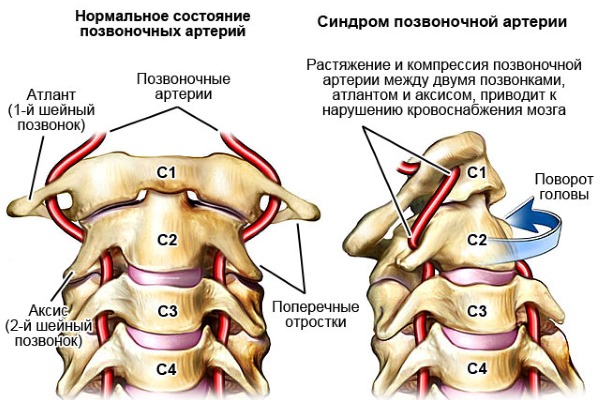 Опасным состоянием является то, когда в шейном отделе пережимается позвоночная артерия
