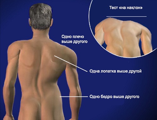 Запомните на что нужно обращать внимание для определения сколиоза