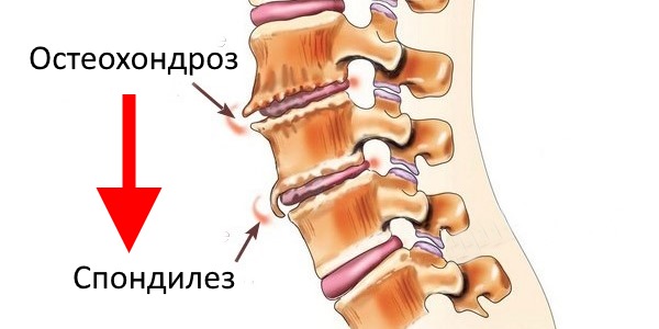 Стоит помнить, что основным фактором развития спондилеза является остеохондроз