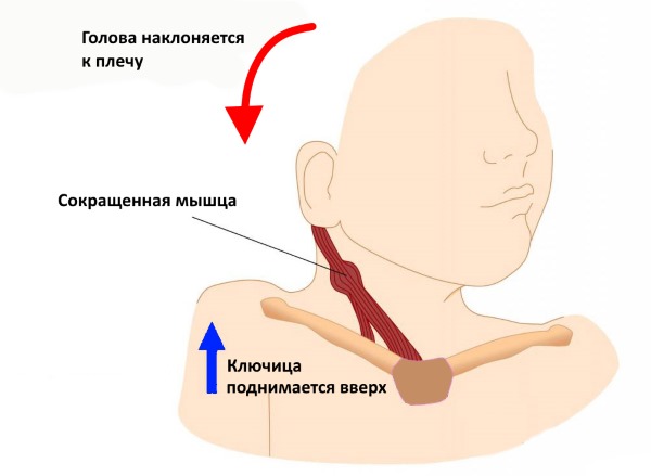 При установочной кривошее происходит сокращение кивательной мышцы с одной стороны