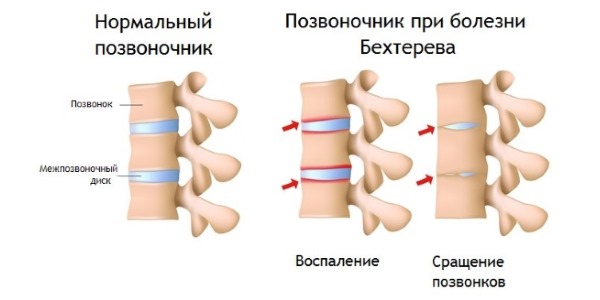Костарокс используют при воспалительных процессах в суставах
