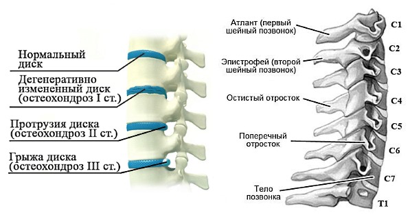 Симптоматика остеохондроза в шейном отделе более выражена, чем при заболевании в других отделах