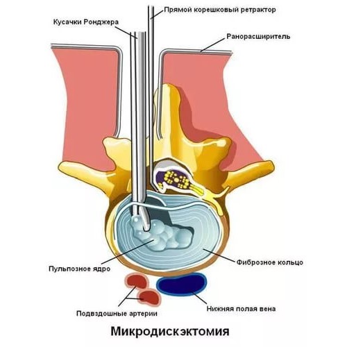 Удаление медианной грыжи выполняется эндоскопическим методом