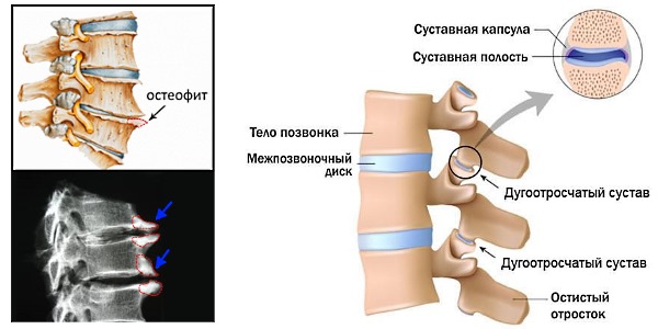 Остеохондроз характеризуется разрастанием остеофитов на позвонках