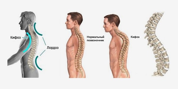 При кифозе происходит выпячивание позвонков назад