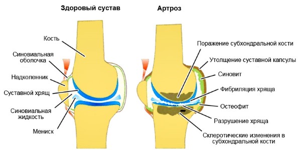 Назначают Матарен Плюс при дегенеративных болезнях, таких как артроз