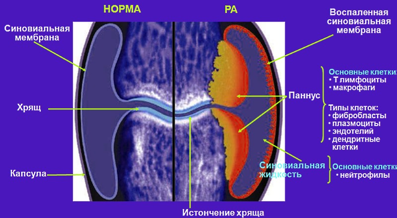 Лекарство Артрозан применяют для устранения воспаления при ревматоидном артрите