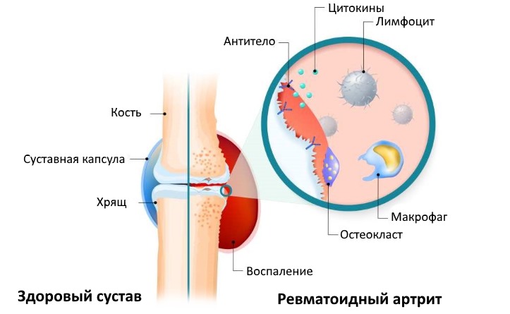 Ацетилсалициловую кислоту часто используют при ревматизме и ревматоидном артрите