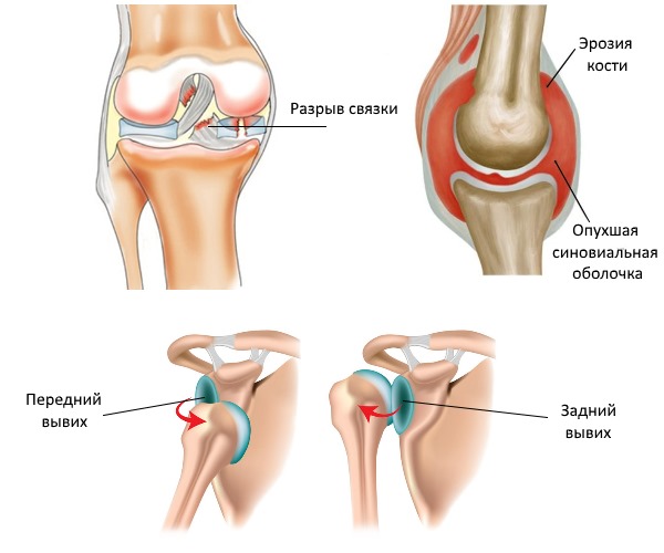 Используют мазь Эспол при различных суставных болях и травмах