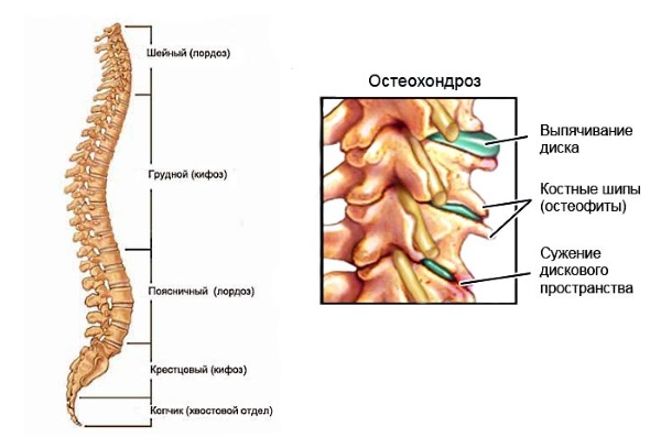 В основном мышечно-тонический синдром возникает на фоне остеохондроза