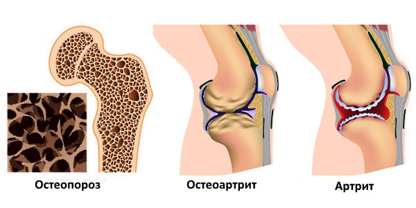 Акулий хрящ применяют для лечения артрита и остеопороза