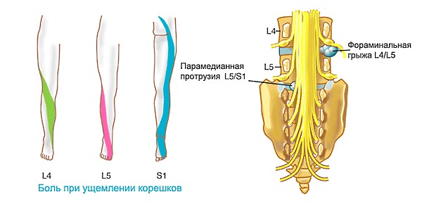 Обратите внимание на локализацию боли при ущемлении нервов в поясничном отделе позвоночника