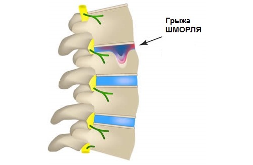 Грыжа Шморля менее опасна и протекает бессимптомно