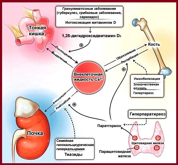 Назначают средство для устранения злокачественных образований в костной ткани и гиперкальциемии