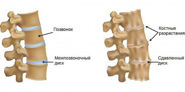 Используется Терафлекс для лечения дегенеративных заболеваний позвоночника