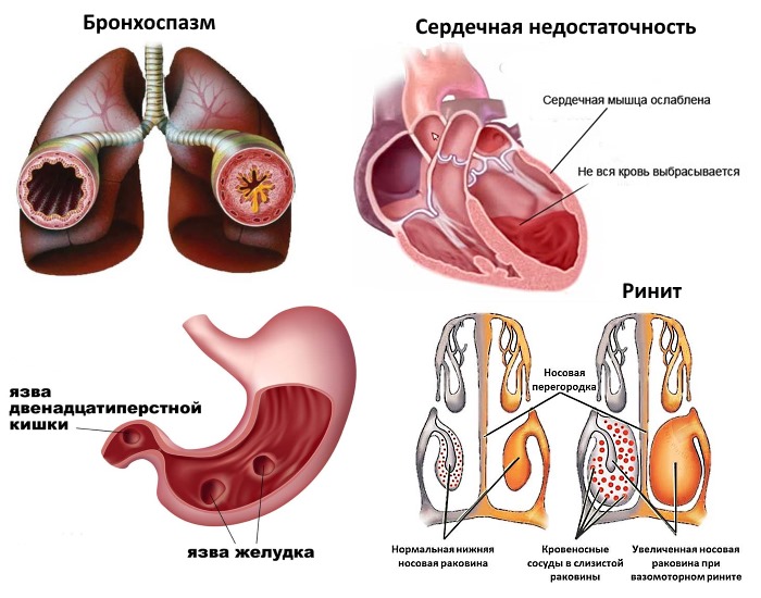 Заболевания, при которых нельзя принимать Мефенаминку. Больше о противопоказаниях ниже