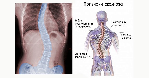 Основой признаков сколиоза является несимметричность тела