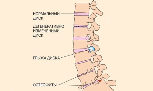 Стадии протекания остеохондроза у каждого индивидуальны