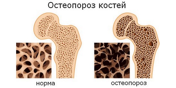 Остеопороз характеризуется потерей плотности костной ткани