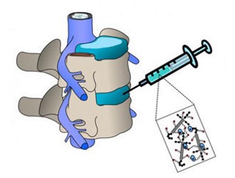 Вылечить протрузию можно на начальной стадии. При грыже можно только снизить проявления симптомов