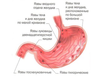 Не используют НПВС при эрозиях и язвах желудка