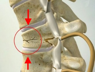 К причинам появления перелома позвоночника относятся травмы позвоночника