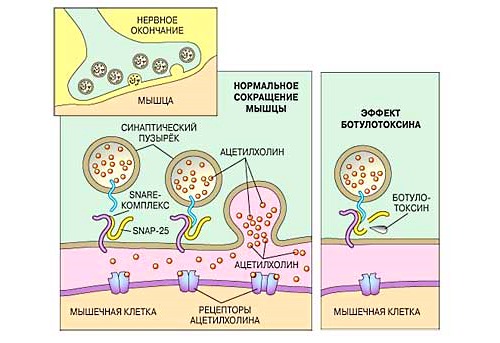 ботулинический токсин типа А позволяет расслабить мышцы